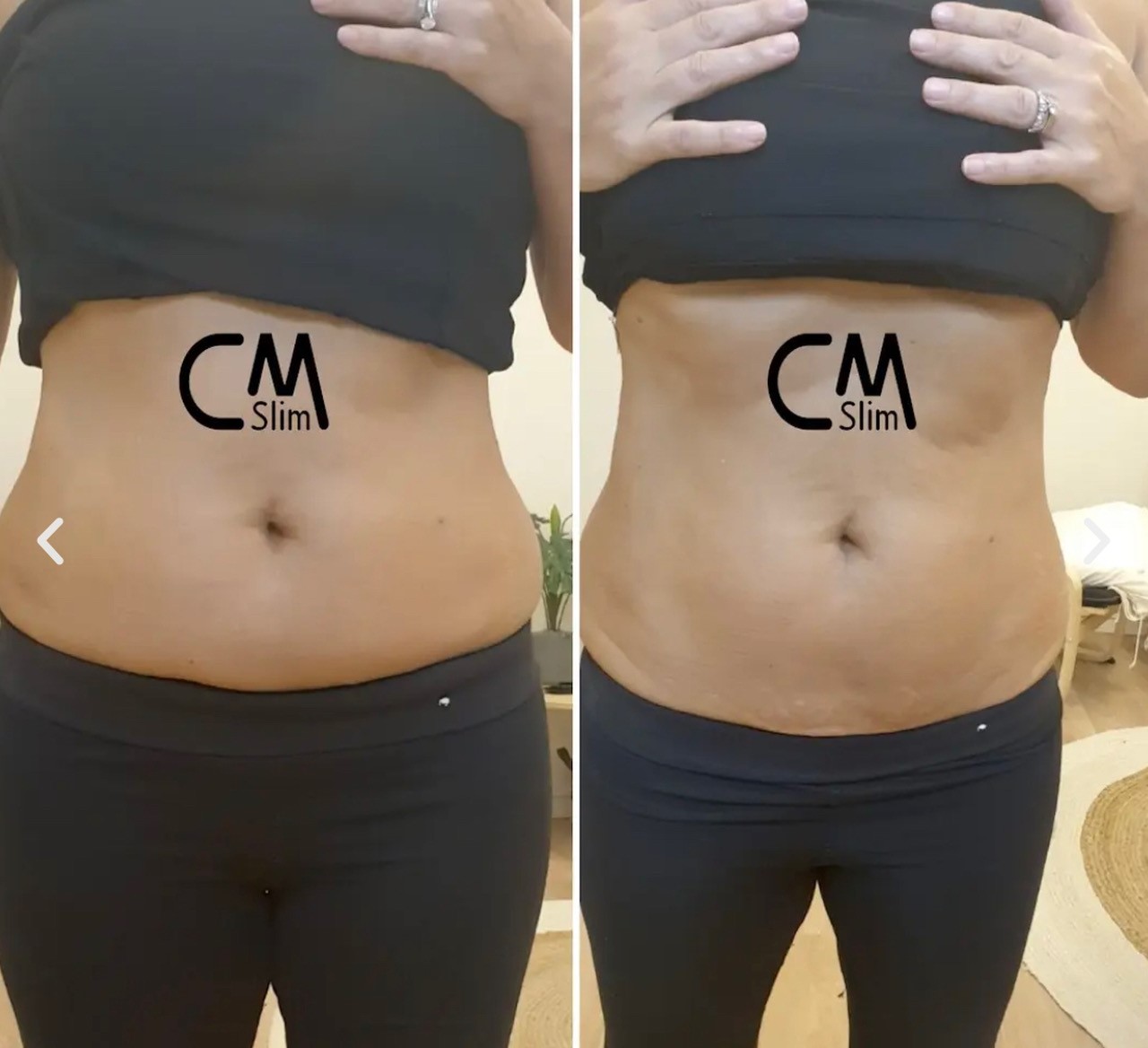 CM Slim - Body Contouring