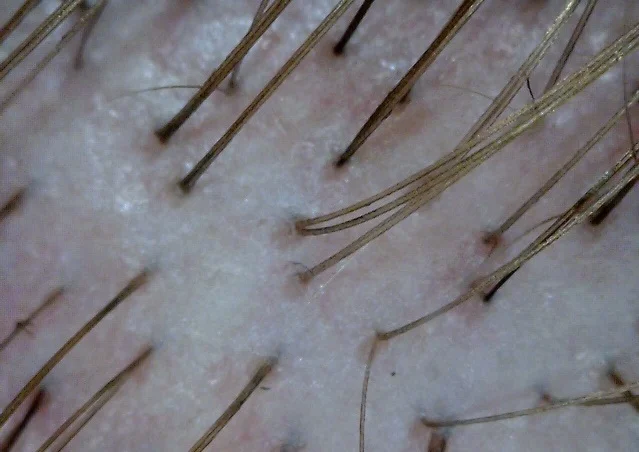 Normal, healthy scalp