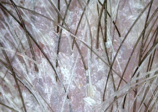 Dry, scaly scalp